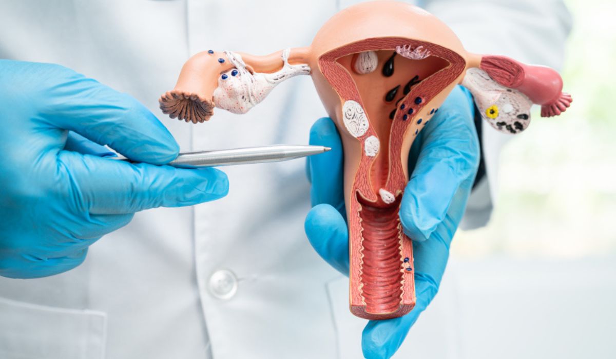 Fibroid Management